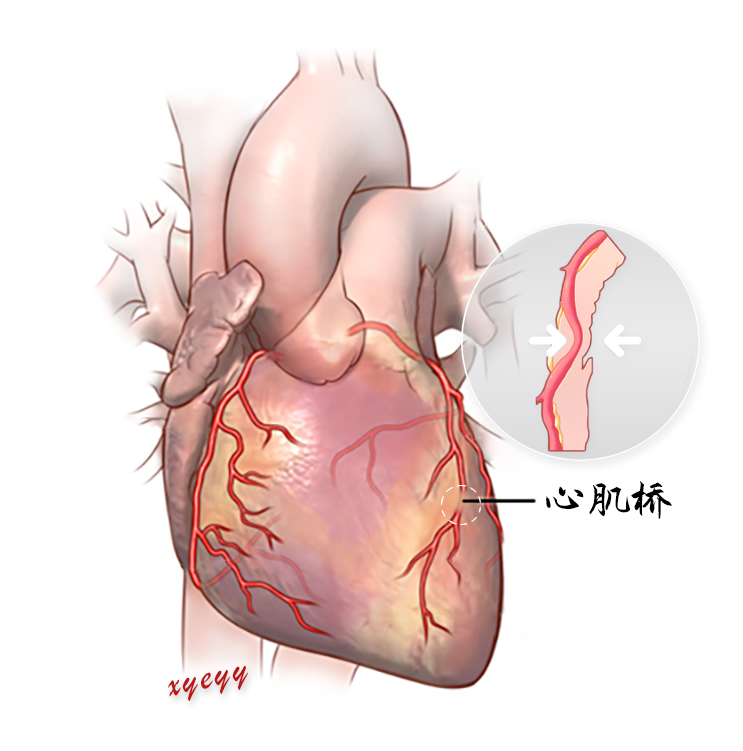心肌桥的最新治疗