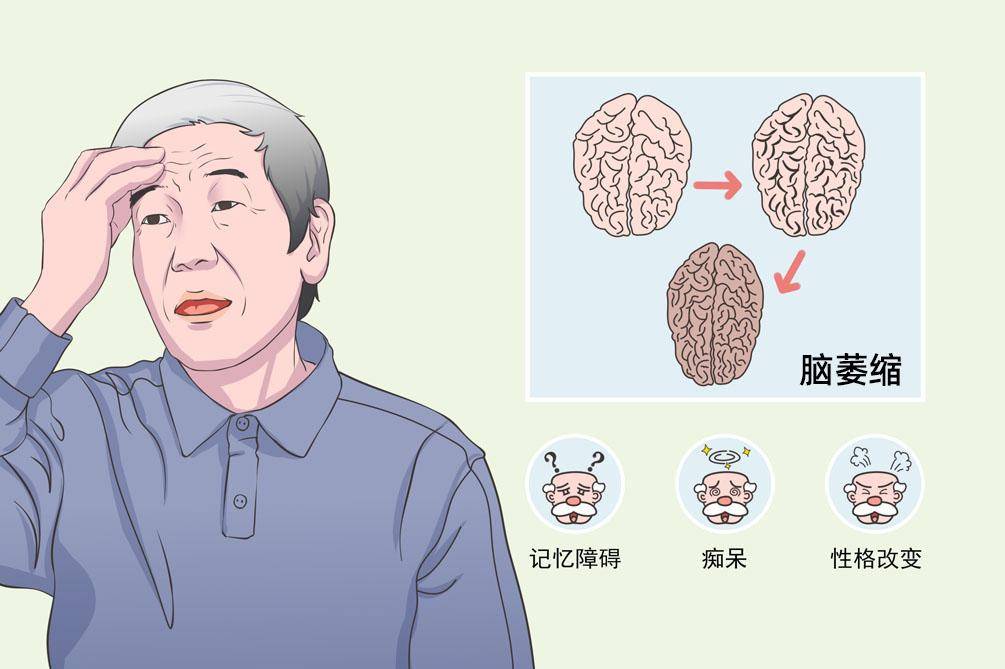 多系统小脑型萎缩最新治疗进展与策略